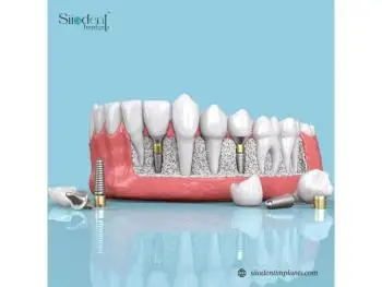 Top Dental Implant Brands in Paraguay Trusted by Dentists