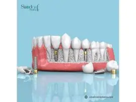 Top Dental Implant Brands in Paraguay Trusted by Dentists