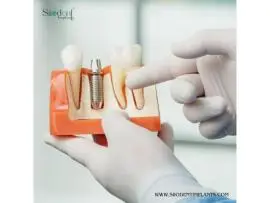 Dental Implant OEM Suppliers in Guatemala for Custom Solutions