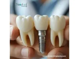 Explore Top Best Dental Implants Brands in Honduras